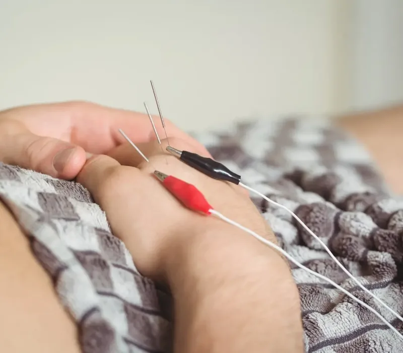 Clinician performing dry needling trigger-point treatment