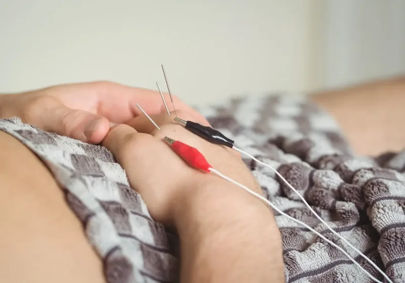 Clinician performing dry needling trigger-point treatment