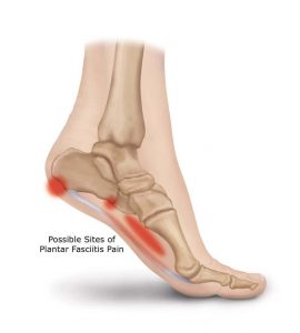 Sites of heel pain