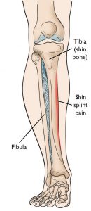 Site of Pain for Shin Splints